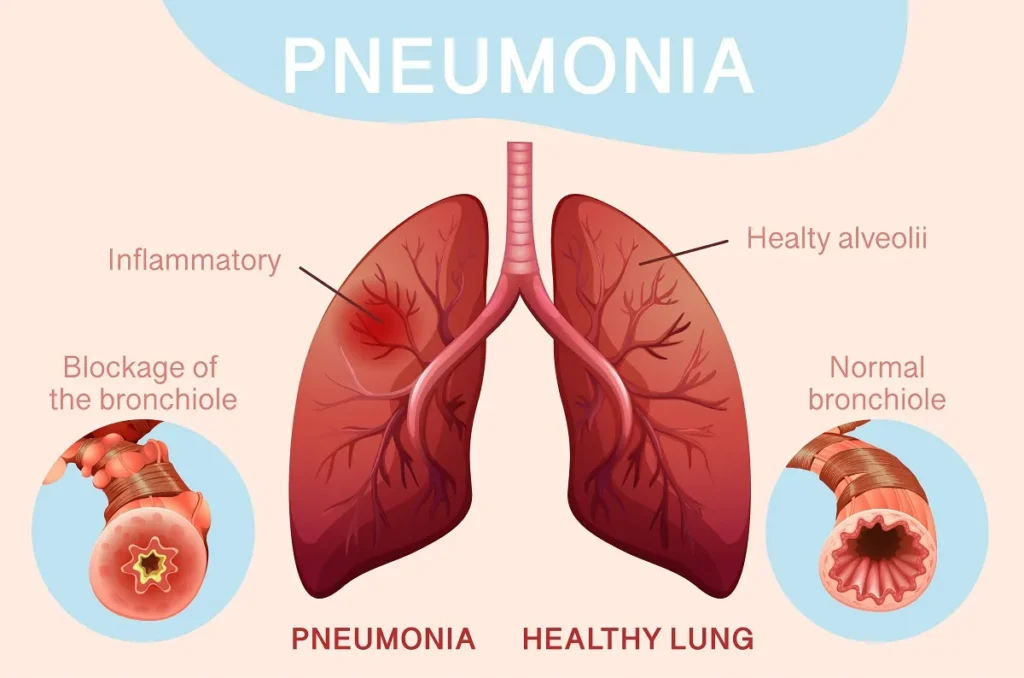 "How to Protect Yourself and Loved Ones from Pneumonia" “Anatomical diagram of the human chest showing the trachea, right and left lungs, bronchi, alveoli, rib cage, and diaphragm, illustrating the respiratory system and areas affected by pneumonia.”